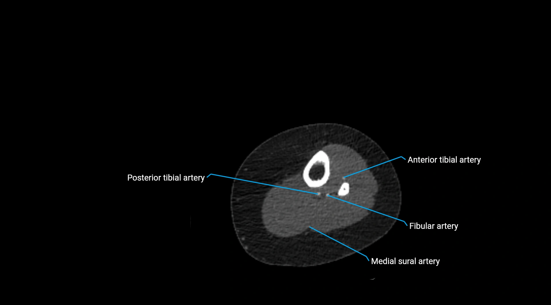 CTA lower limb cross sectional anatomy labelled image _205.webp